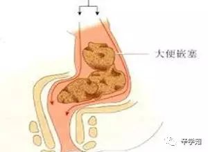 长期的便秘或粪嵌塞的病人,因粪便刺激肛门直肠压力感受器而粪便又