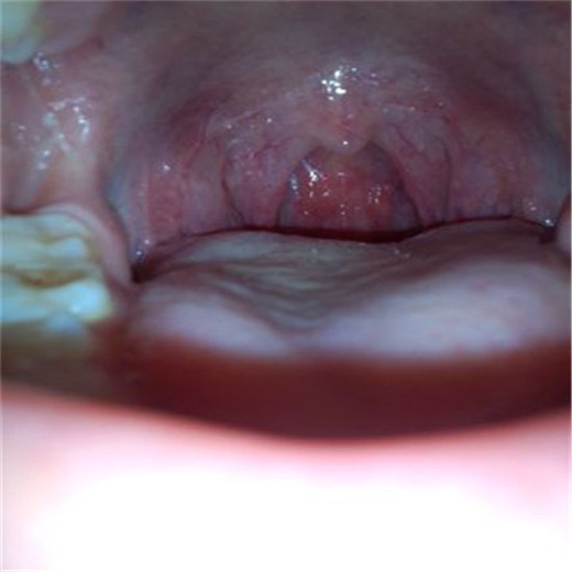 扁桃體腫大圖片 (46)