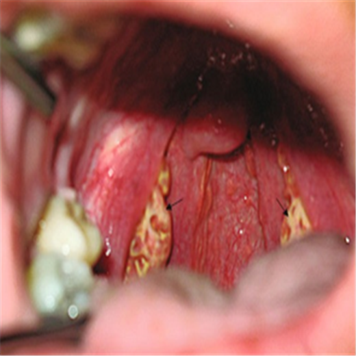 扁桃體腫大圖片 (49)