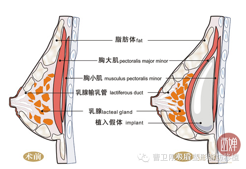 丰胸,哪种方式适合你?