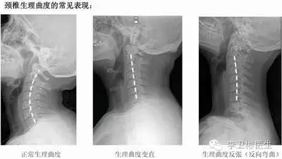 颈椎生理曲度改变