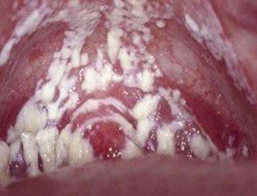 口腔念珠菌感染 (44)