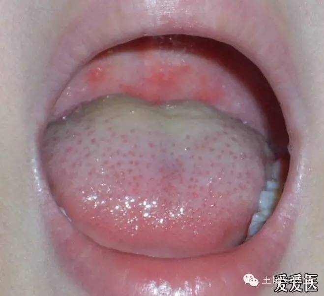 小儿口腔疱疹主要表现急性疱疹性龈口炎