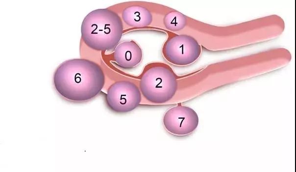 figo子宫肌瘤分型示意图