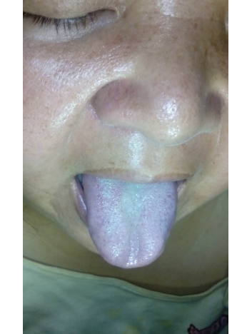 胃炎的症状舌头图片 (7)