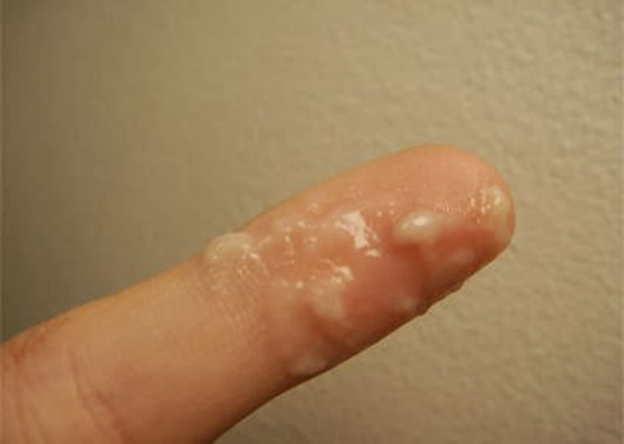 宮頸糜爛二度 (40)