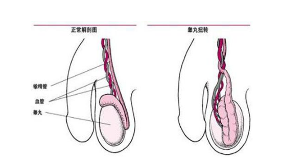 精索曲张睾丸下坠时图片 (48)