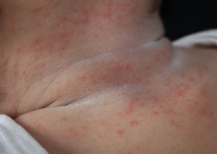 婴儿干性湿疹图片 (59)
