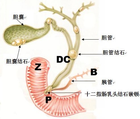 胆囊结石必须手术切除吗