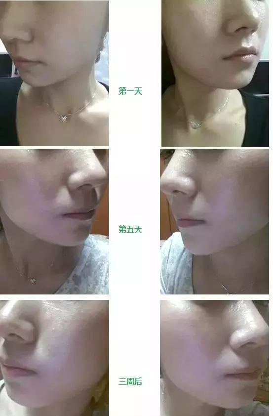 停用水光针后,皮肤比以前还差?