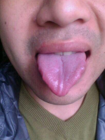 胃炎的症状舌头图片 (50)