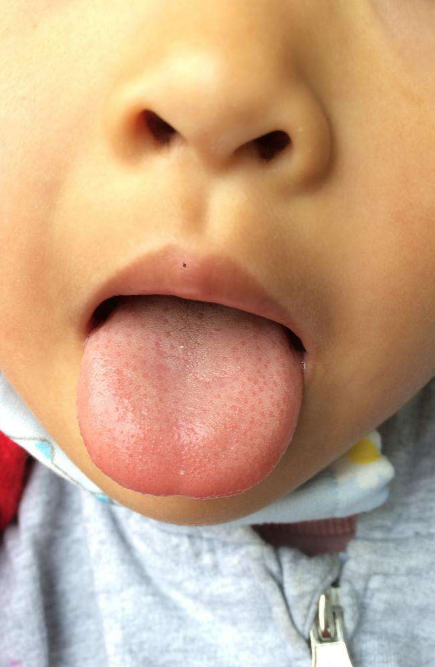 胃炎的症状舌头图片 (8)