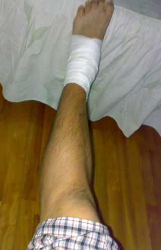 脚踝韧带拉伤 (65)