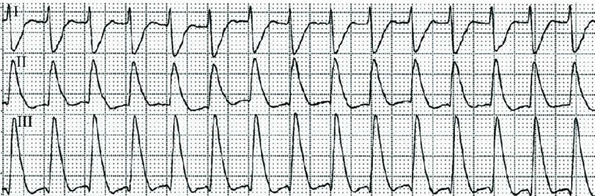 房颤心电图特点 (68)