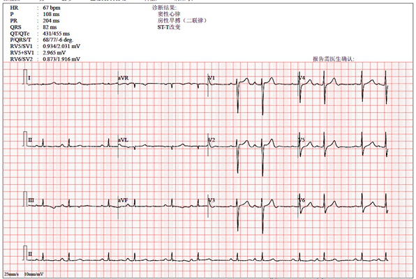 房颤心电图特点 (70)