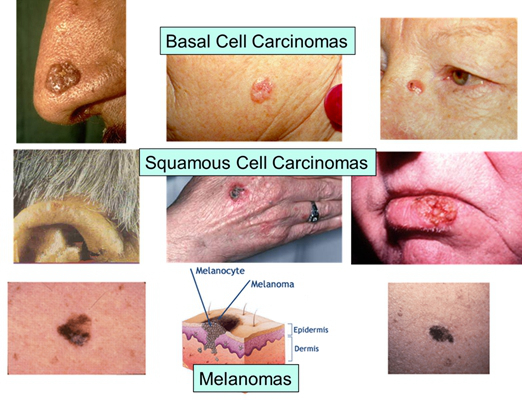 皮肤癌的早期特征图片 (6)