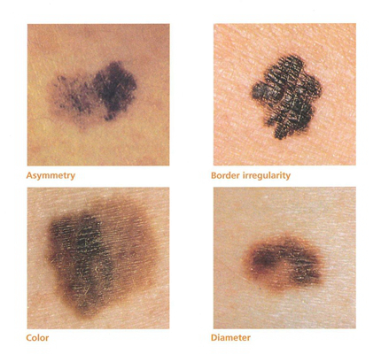 皮肤癌的早期特征图片 (62)