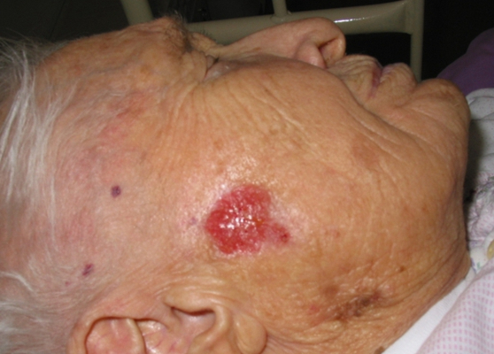 皮肤癌的早期特征图片 (68)