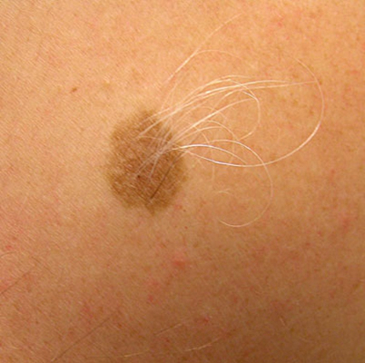 皮肤癌的早期特征图片 (60)
