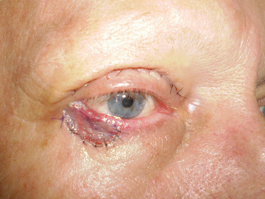 皮肤癌的早期特征图片 (63)