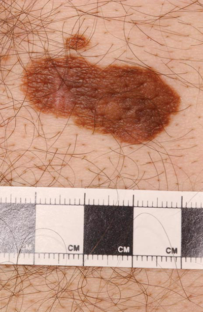 皮肤癌的早期特征图片 (7)