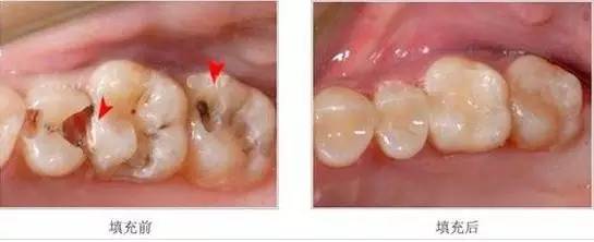 牙齿龋坏有牙洞，补牙要趁早