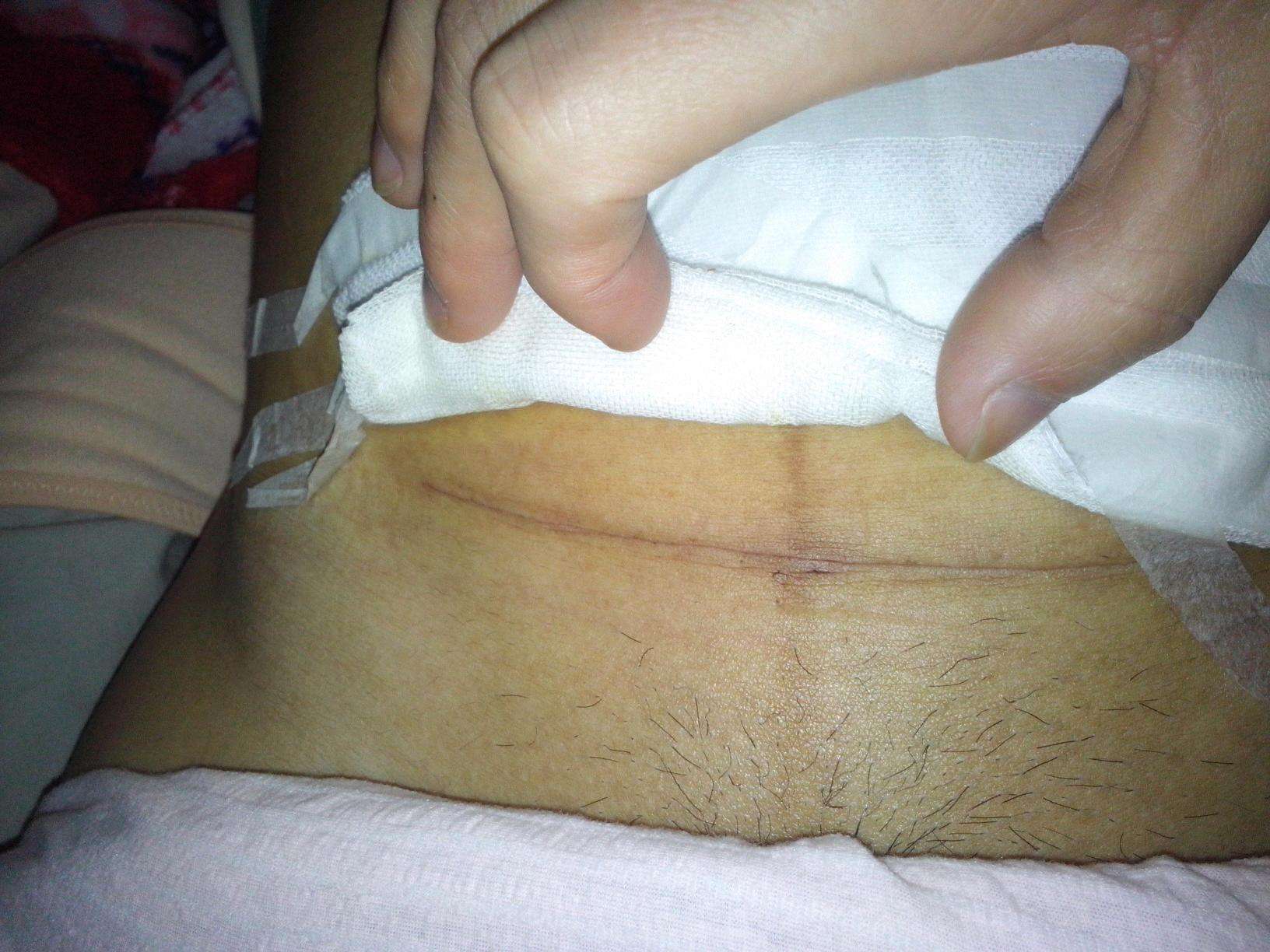 女人最多能做几次剖腹产?