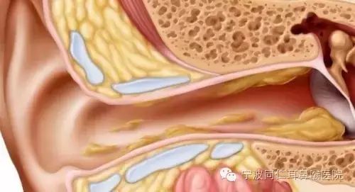 耳屎多,到底该怎么办?