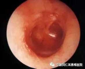 孩子患哪些病极易致耳聋?
