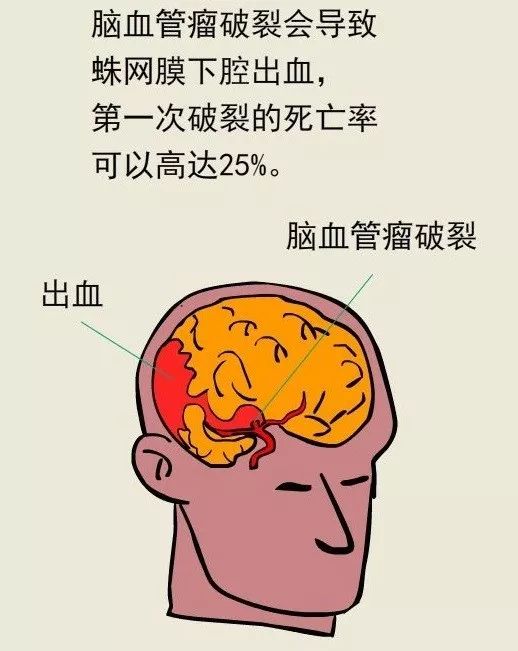 脑出血悄悄找上年轻人,你还在熬夜吗?