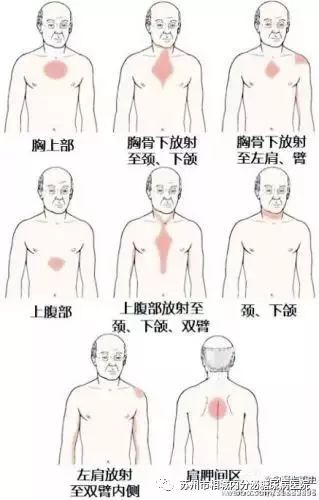 发生放射性的疼痛,而且放射痛的范围很广,包括胃,下巴,肩膀,颈部,后背