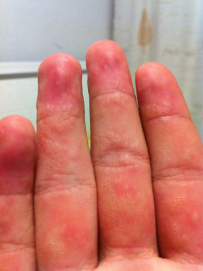 手指湿疹症状图片 (66)