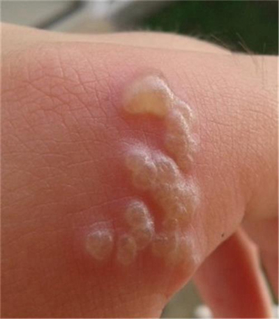 手指湿疹症状图片 (69)
