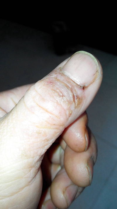 手指湿疹症状图片 (71)