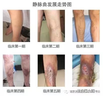 日常保健下肢静脉曲张方法