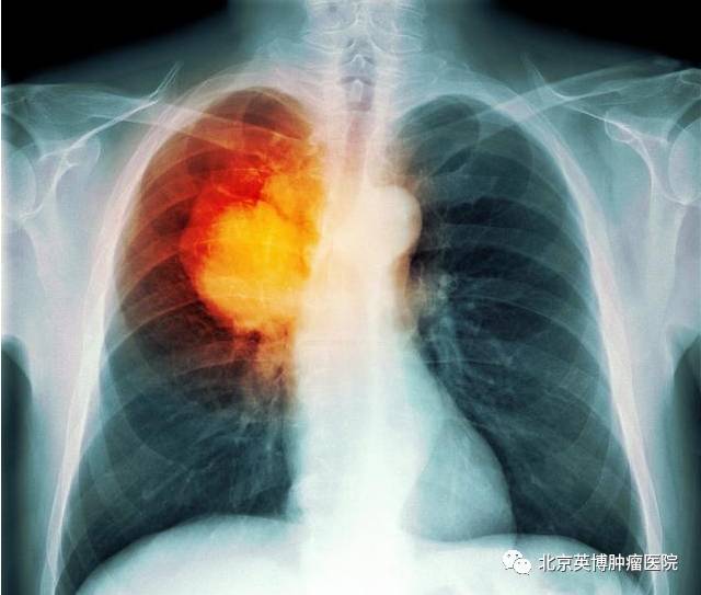 肺癌晚期有治好的吗?有没有人知道治疗方法?