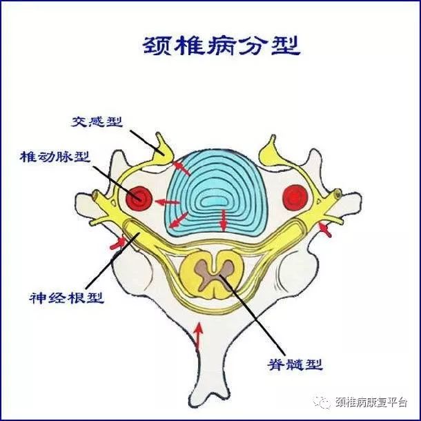 面对颈椎病问题,常见的共性误区有哪些?