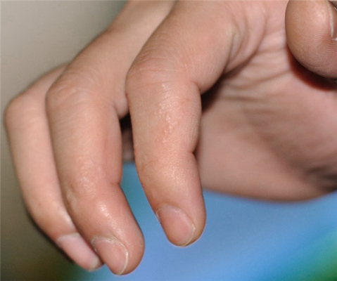 手指湿疹症状图片 (72)