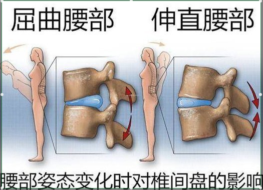 腰椎間盤突出癥狀表現(xiàn) (35)