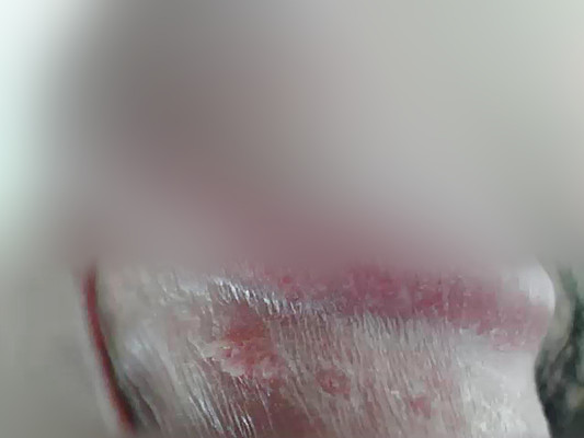 男性尿道尖銳濕疣 (46)