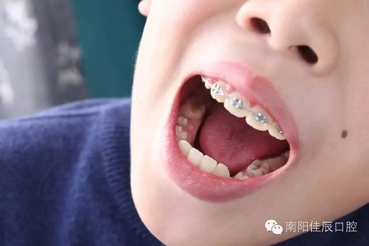 幼儿牙齿健康必知的保健常识