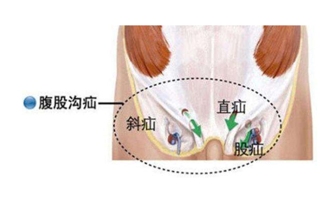 股疝圖片 (1)