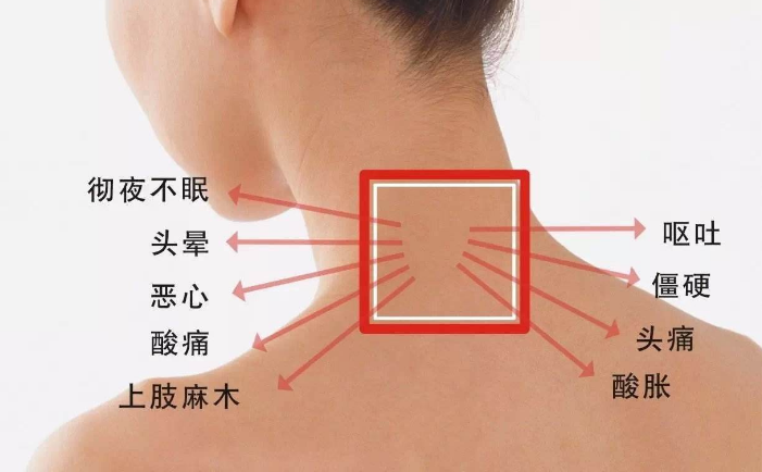 頸椎病的癥狀圖片 (2)