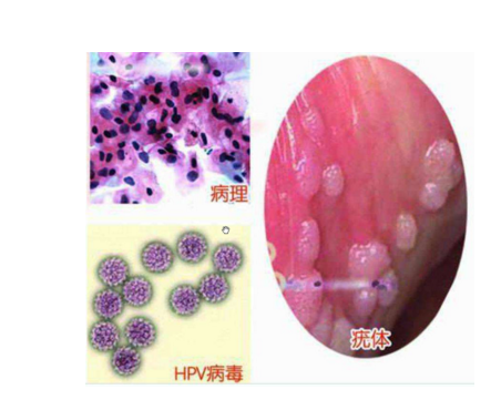 女性尖銳濕疣癥狀 (1)