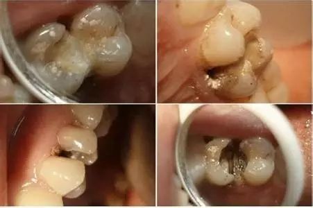 蛀牙是因为口腔卫生不佳引起的,牙齿已经被细菌腐蚀变黑,若是不及时