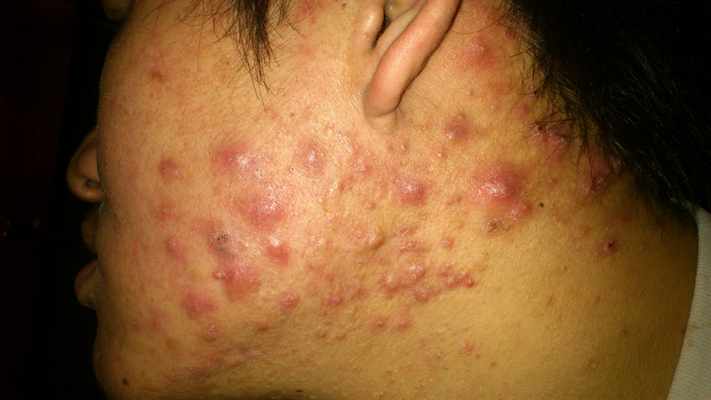 血热的症状痘痘图片 (5)