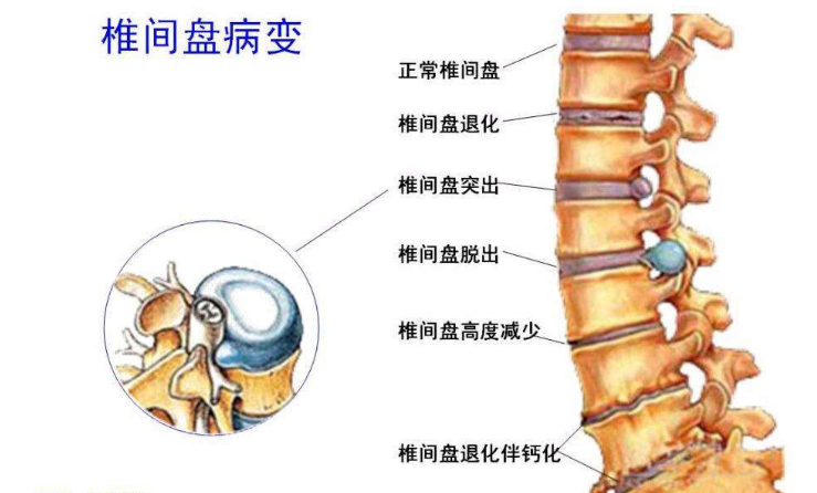 腰椎間盤(pán)突出癥狀表現(xiàn) (7)