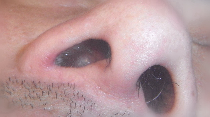 鼻窦炎症状图片 (81)