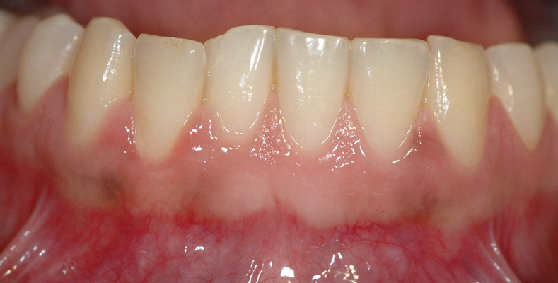 牙癌的症状和外部图片 (9)