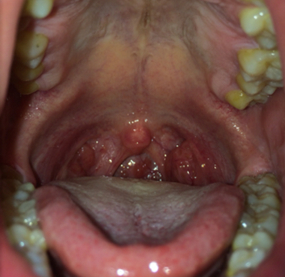喉咙长了个囊肿图片(38)
